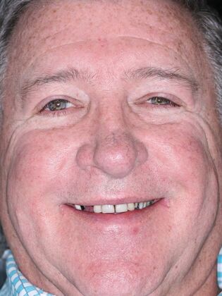 Dental Implants Jeff - Before