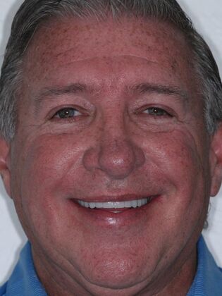 Dental Implants Jeff - After