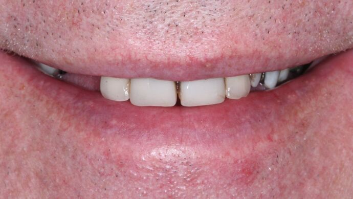 Dental Implants: Jeff - Before