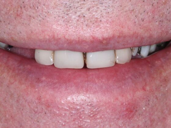 Dental Implants: Jeff - Before