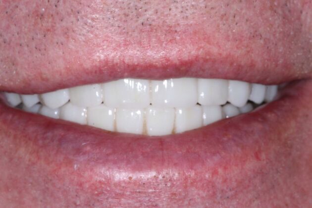 Dental Implants: Jeff - After