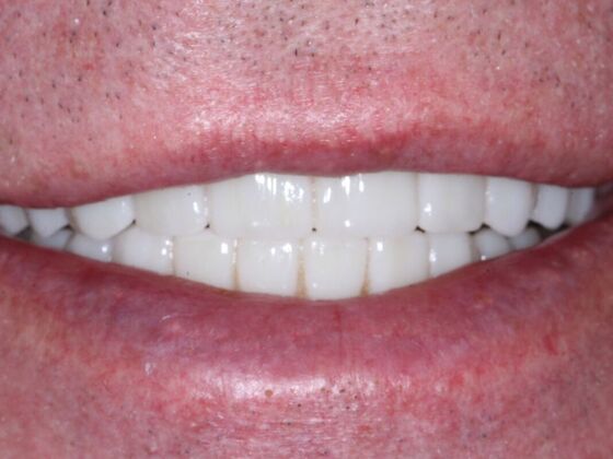Dental Implants: Jeff - After