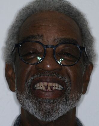 Dental Implants Ken - Before