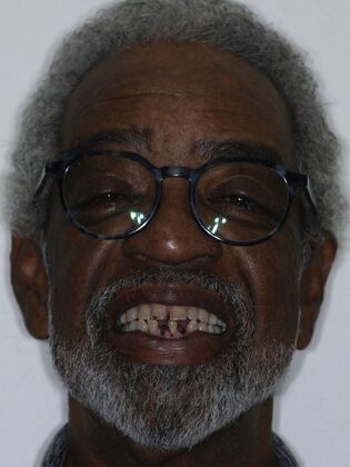 Dental Implants Ken - Before