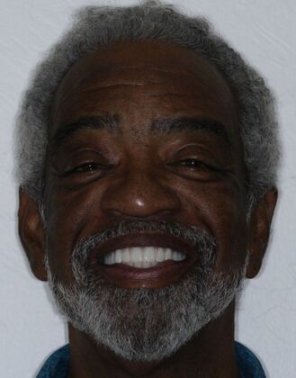 Dental Implants Ken - After