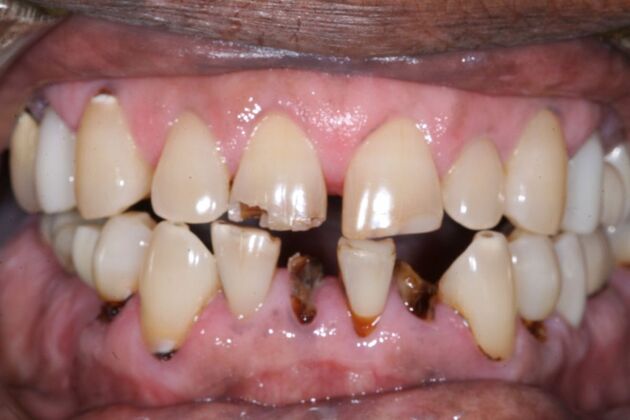 Dental Implants: Ken - Before