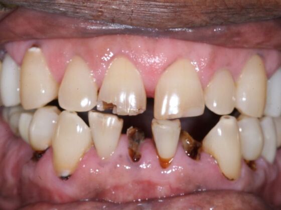 Dental Implants: Ken - Before