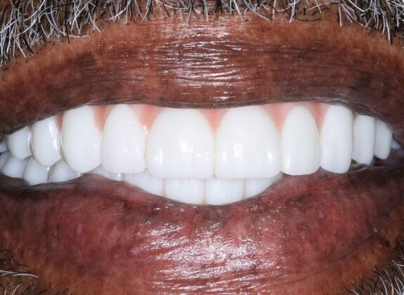 Dental Implants: Ken - After