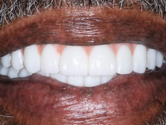 Dental Implants: Ken - After