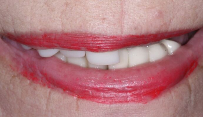 Dental Implants: Leslie - Before