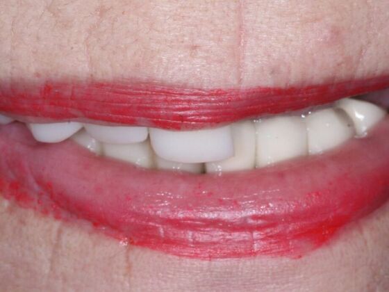 Dental Implants: Leslie - Before