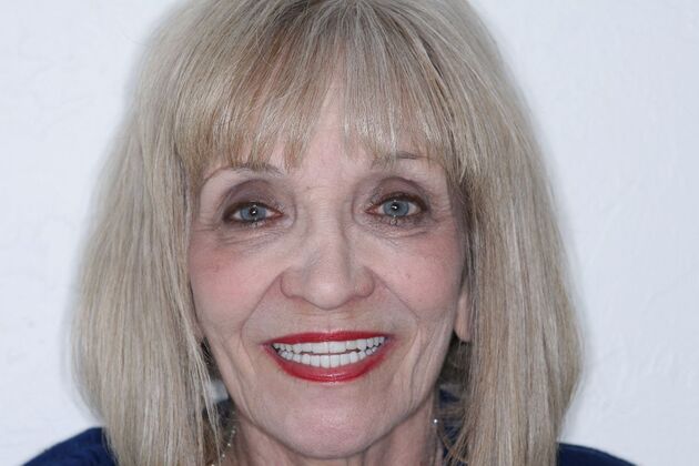 Dental Implants Leslie - After