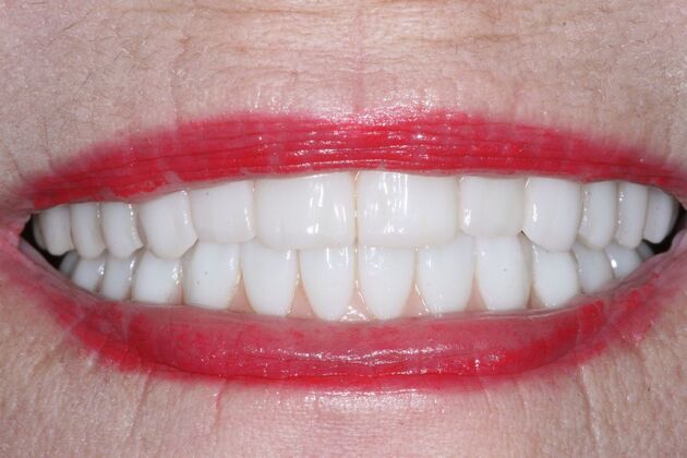 Dental Implants: Leslie - After