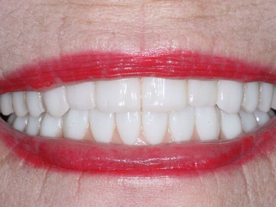 Dental Implants: Leslie - After