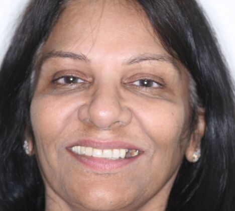 Dental Implants Zareen - Before