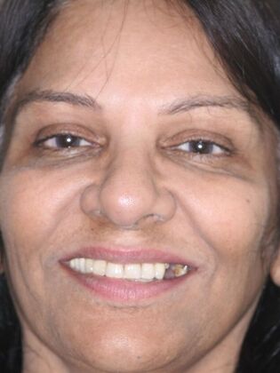 Dental Implants Zareen - Before