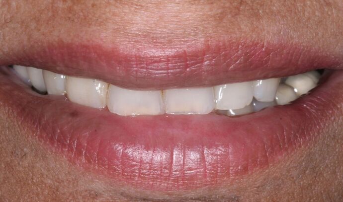 Dental Implants: Zareen - Before