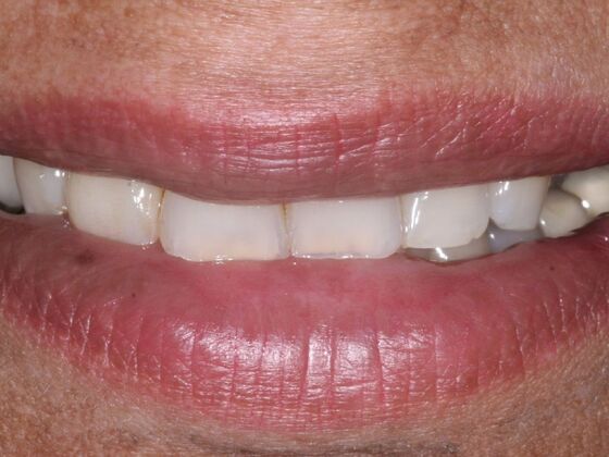 Dental Implants: Zareen - Before