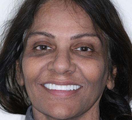 Dental Implants Zareen - After