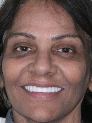 Dental Implants Zareen - After