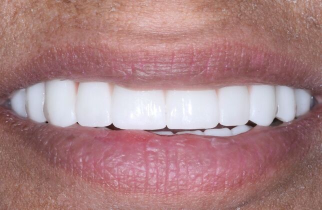 Dental Implants: Zareen - After