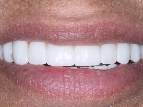 Dental Implants: Zareen - After