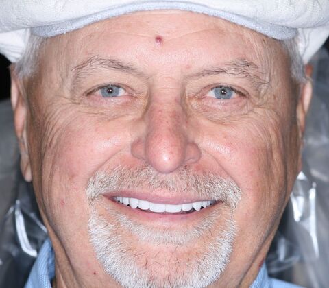 Veneers Daryl - After