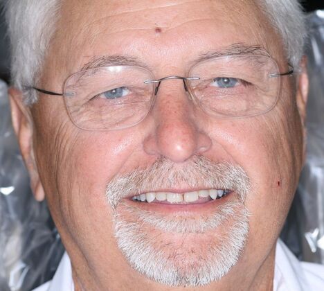 Veneers Daryl - Before