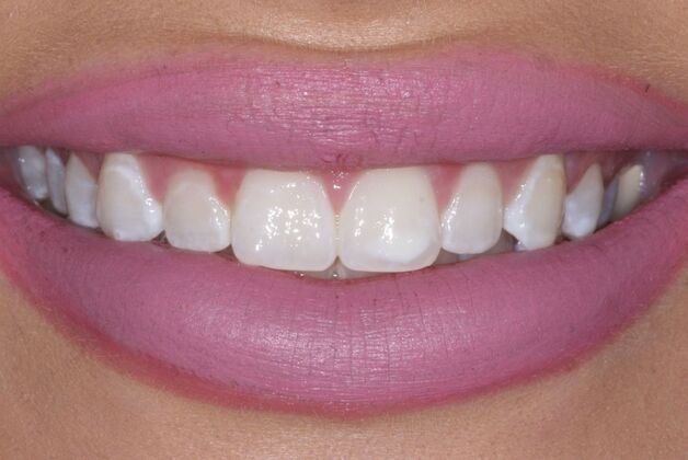 Veneers Madison - Before