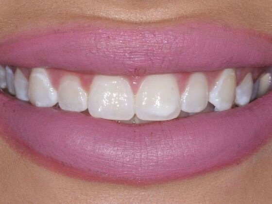 Veneers Madison - Before
