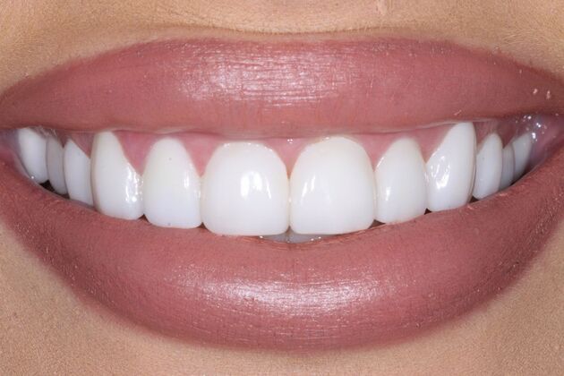 Veneers Madison - After