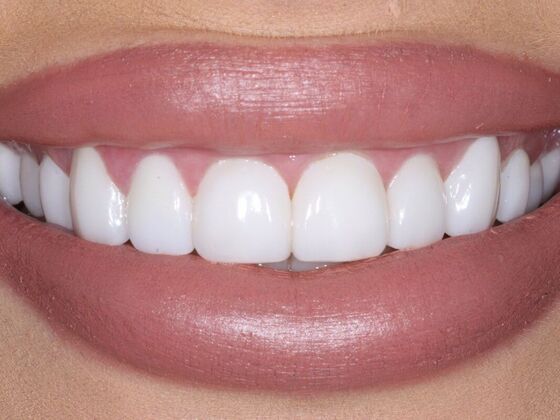 Veneers Madison - After