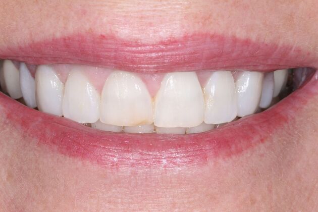 Veneers: Tammy - Before