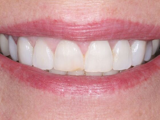 Veneers: Tammy - Before