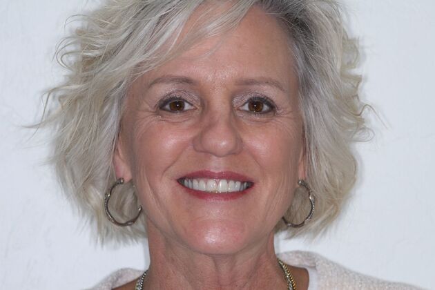 Veneers Tammy - Before