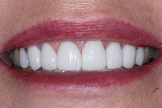 Veneers: Tammy - After