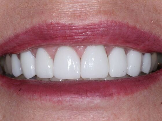 Veneers: Tammy - After