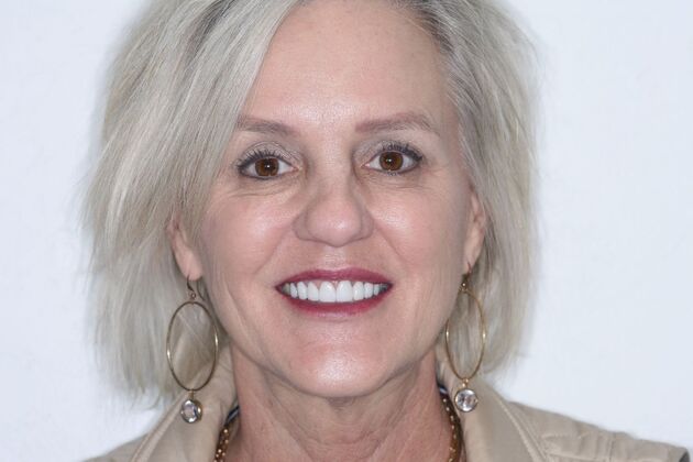 Veneers Tammy - After