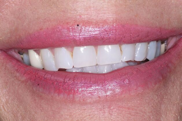 Crowns: Kay - Before