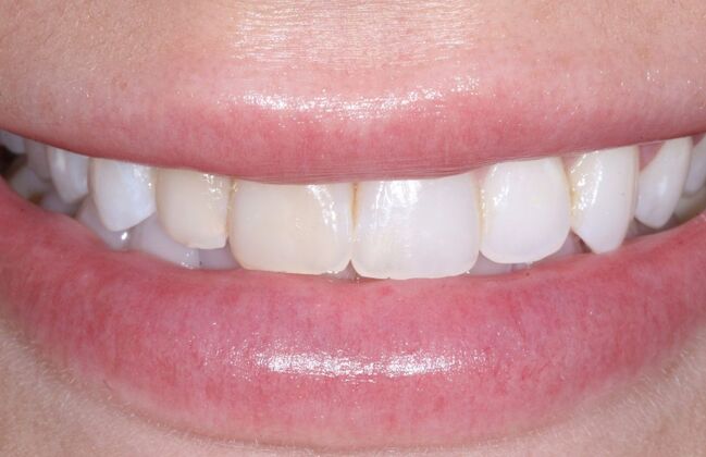Veneers Logan - Before