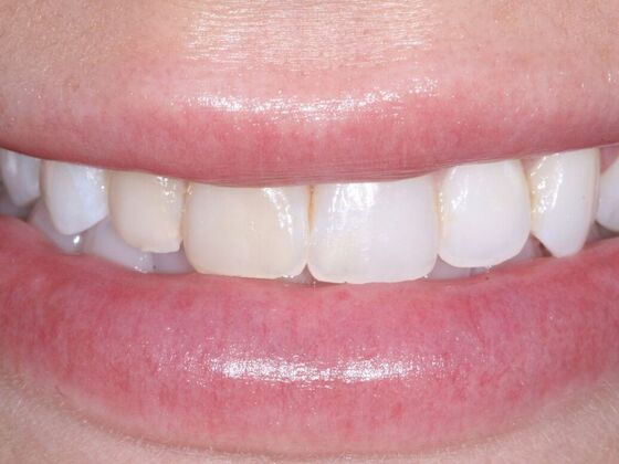Veneers Logan - Before