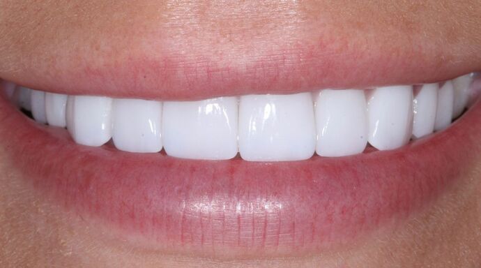 Veneers Logan - After