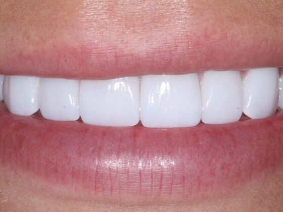 Veneers Logan - After