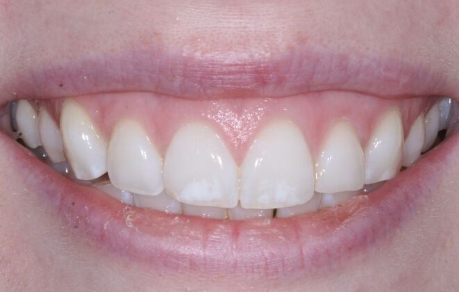 Veneers Hannah - Before