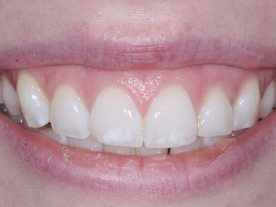 Veneers Hannah - Before