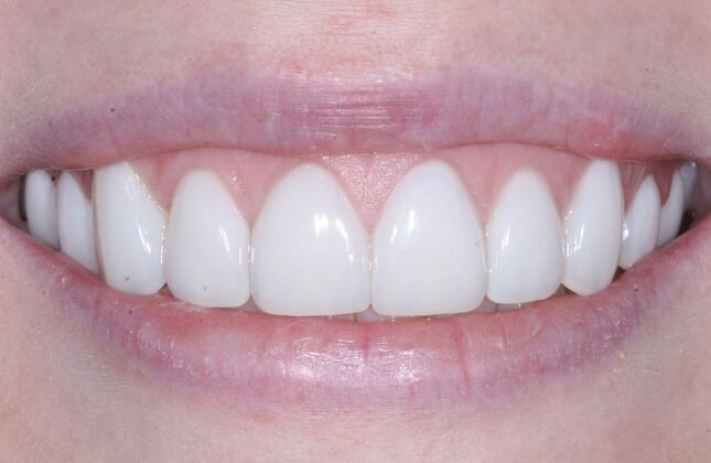 Veneers Hannah - After