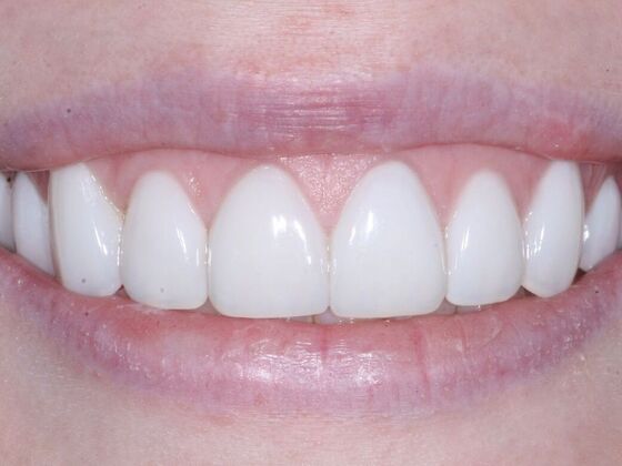 Veneers Hannah - After