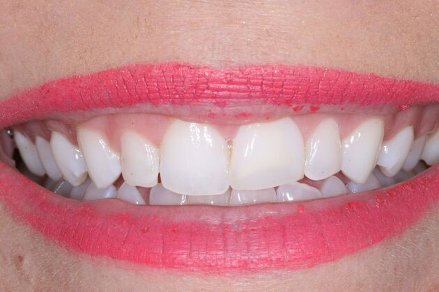 Veneers Cassidy - Before