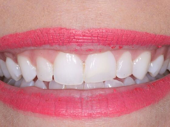 Veneers Cassidy - Before