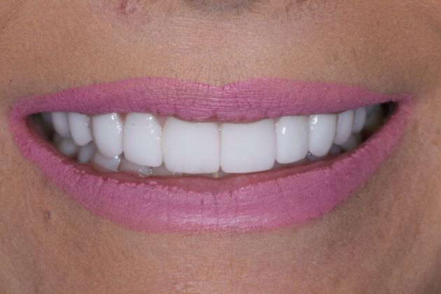 Veneers Cassidy - After